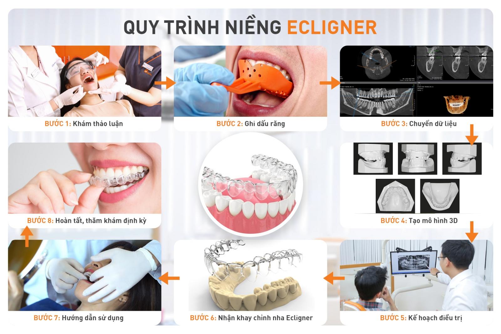 quy trình niềng răng ecligner