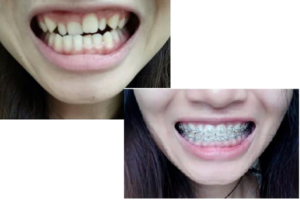 hinh anh truoc va sau khi nieng rang