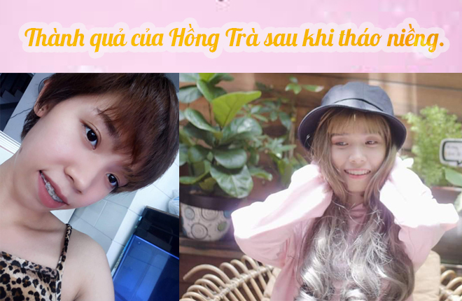 niềng răng