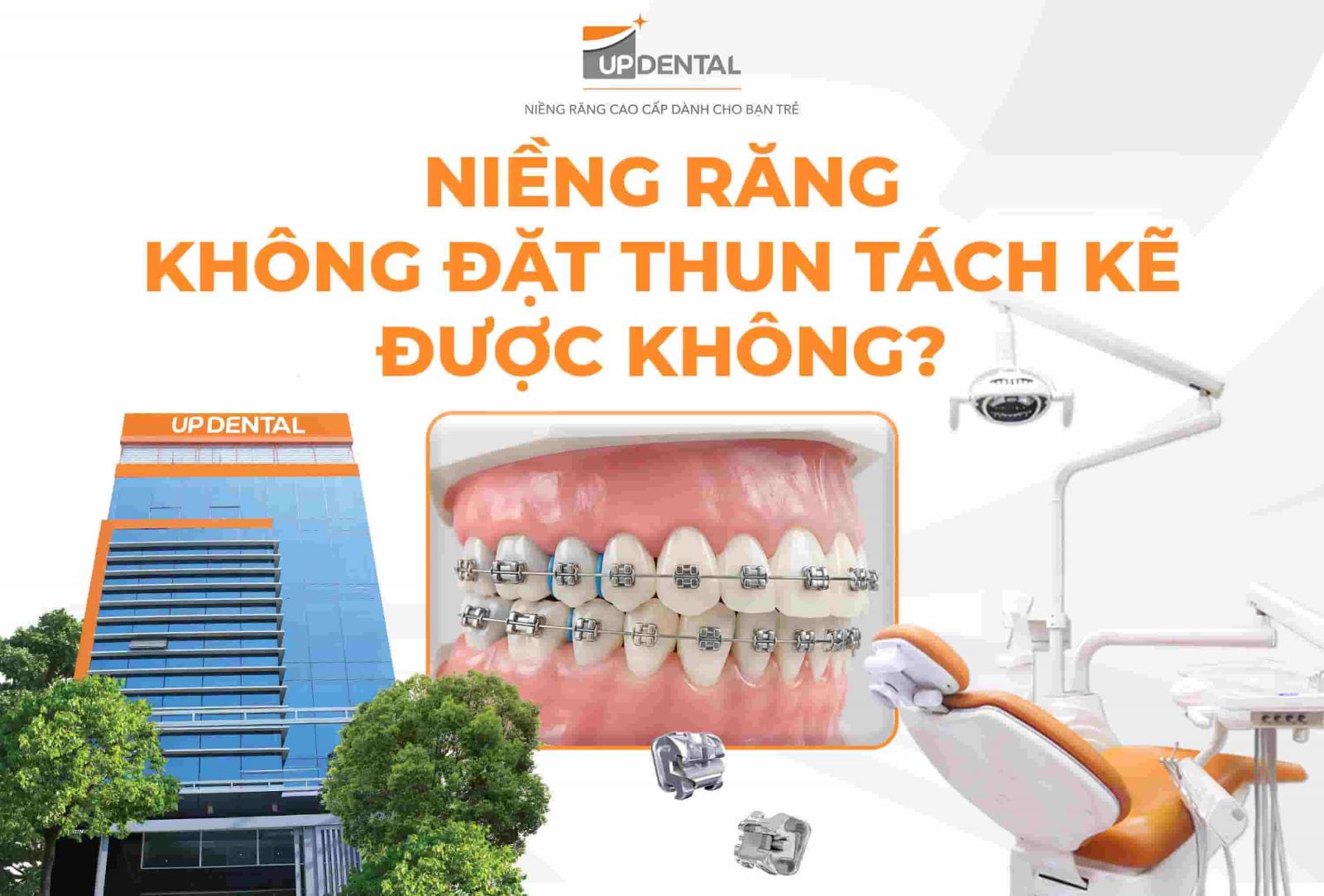 Niềng răng không đặt thun tách kẽ được không?