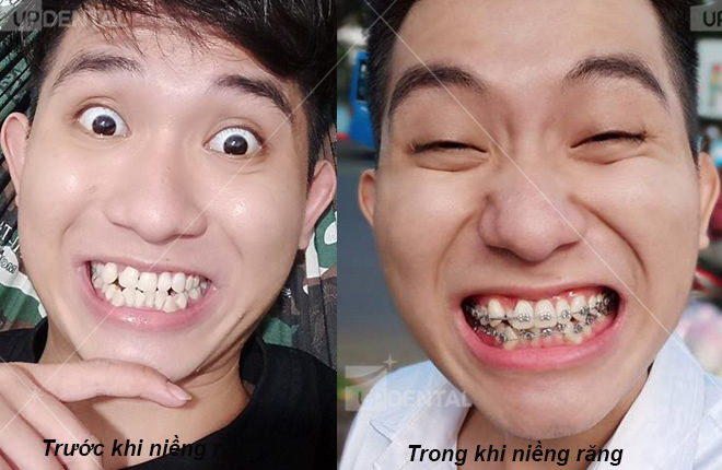hinh anh truoc va trong khi nieng rang