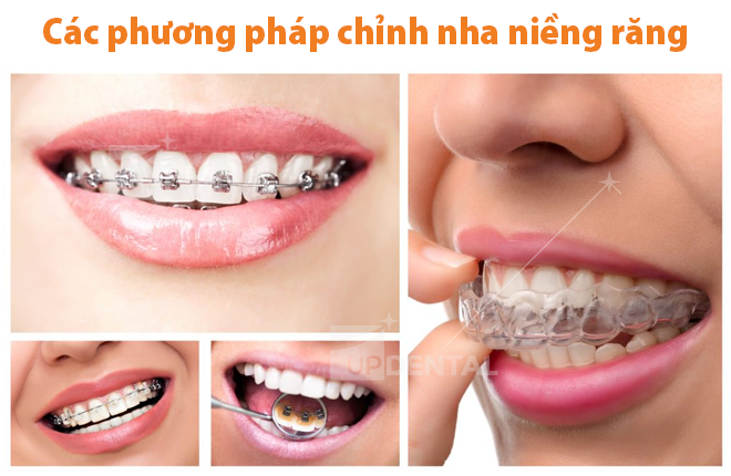 cac phuong phap nieng rang