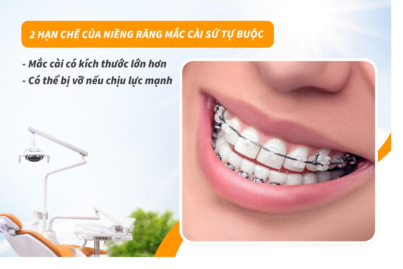2 hạn chế của niềng răng mắc cài sứ tự buộc