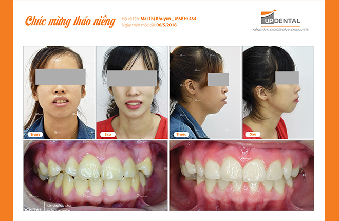 Hình ảnh trước và sau khi niềng răng của Mai Thị Khuyên