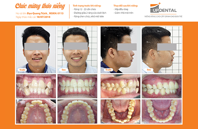 Trước và sau khi niềng răng của Quang Trịnh
