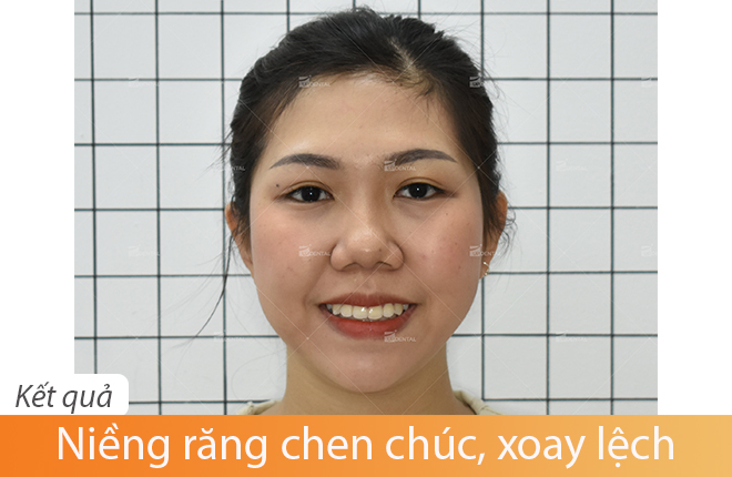 hình ảnh răng thay đổi sau khi niềng 