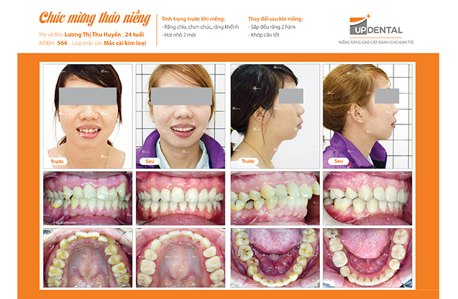 Review niềng răng Up Dental