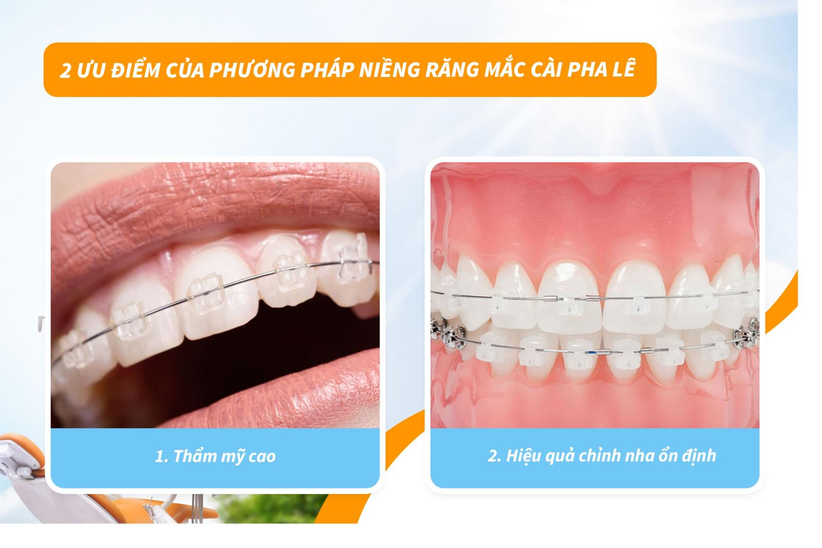 2 ưu điểm của phương pháp niềng răng mắc cài pha lê