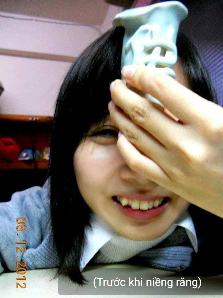Hinh anh truoc khi nieng rang