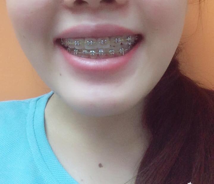 review ket qua nieng rang tai nha khoa up dental