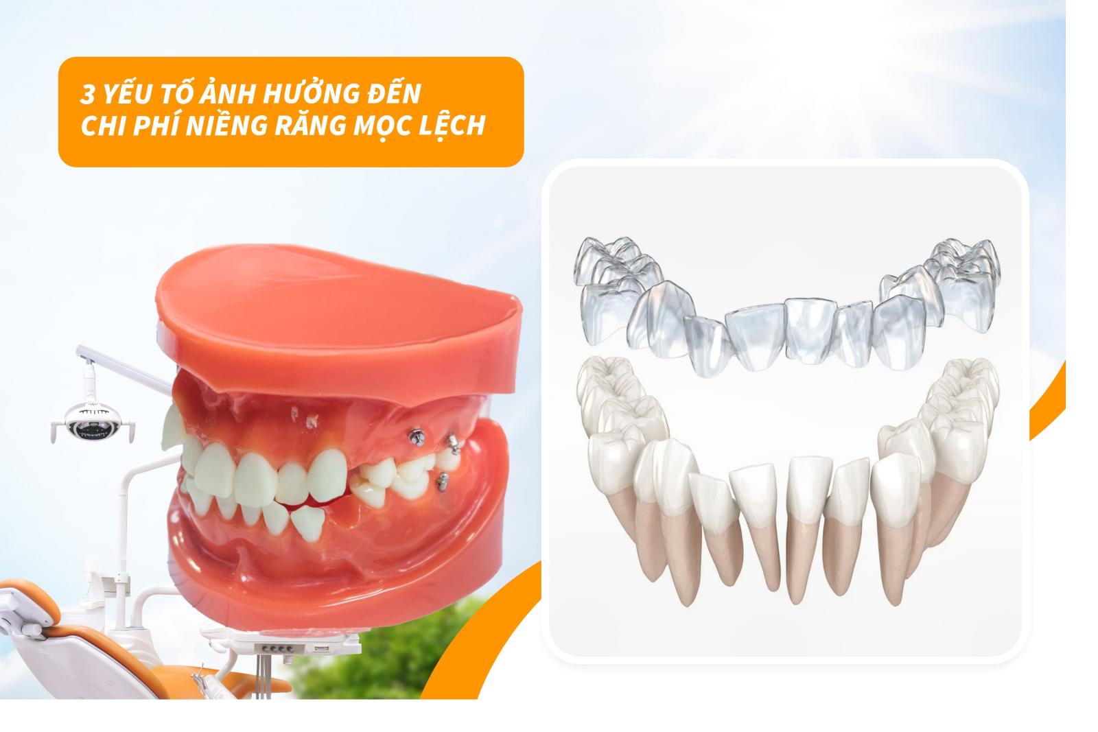 Những yếu tố ảnh hưởng đến chi phí niềng răng mọc lệch