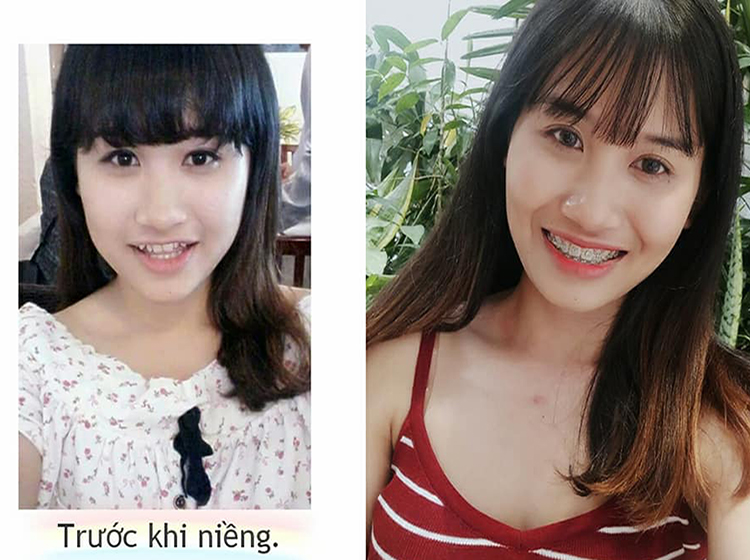 hinh anh ket qua truoc khi nieng rang va sau khi nieng rang