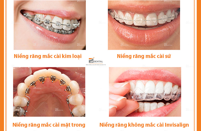 4 phương pháp niềng răng hô hiệu quả