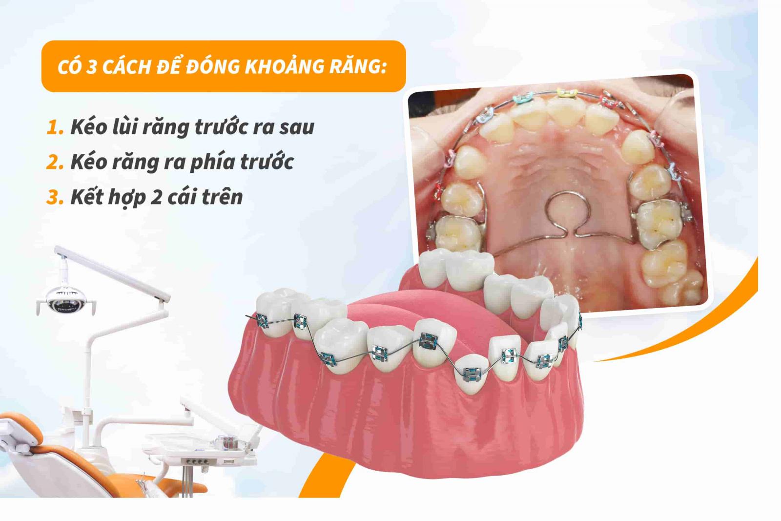 Giai đoạn đóng khoảng khi niềng răng