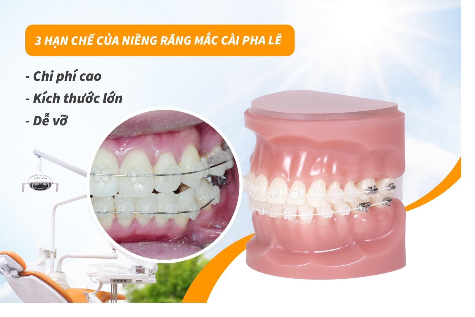 3 hạn chế của niềng răng mắc cài pha lê