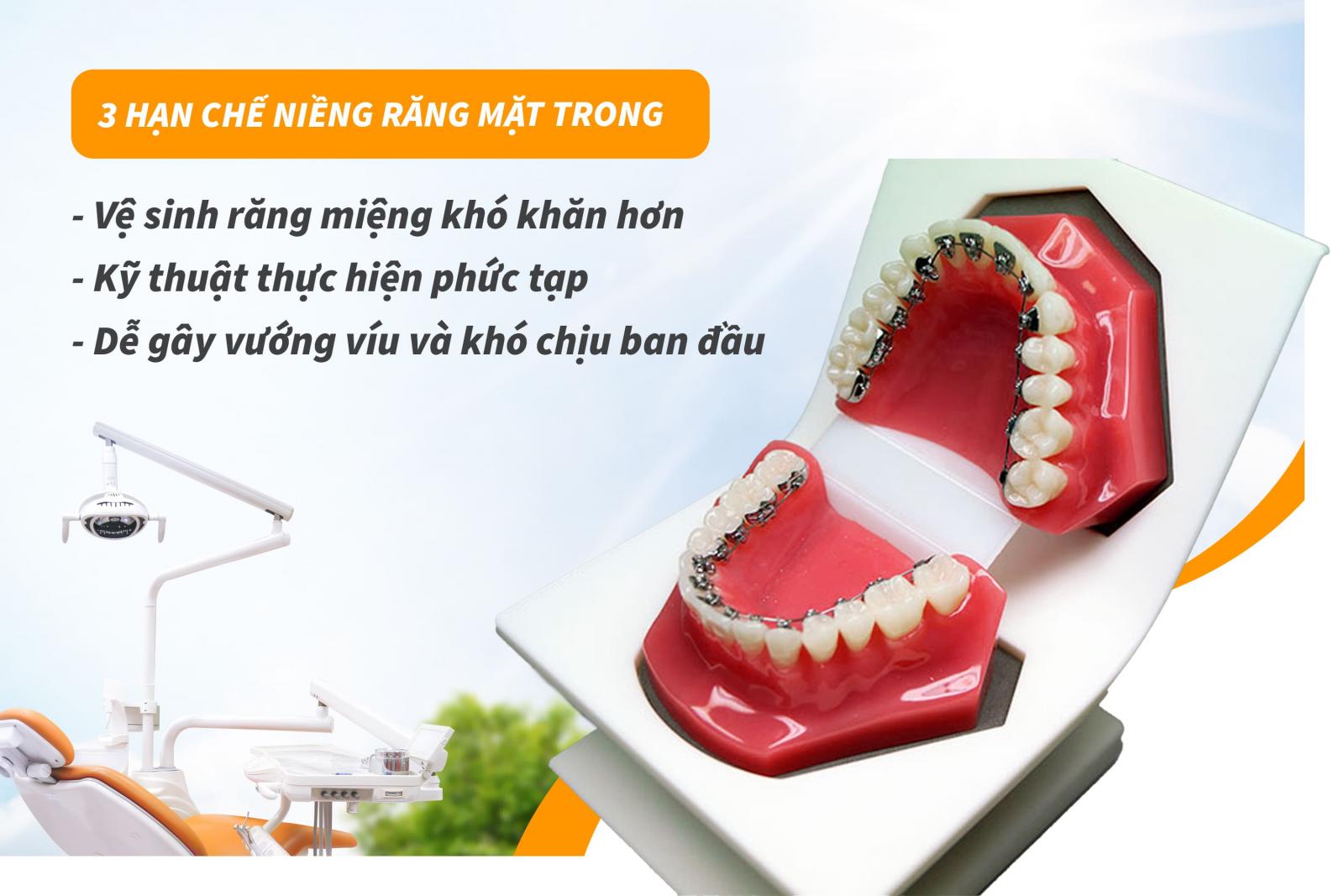 3 hạn chế của niềng răng mặt trong