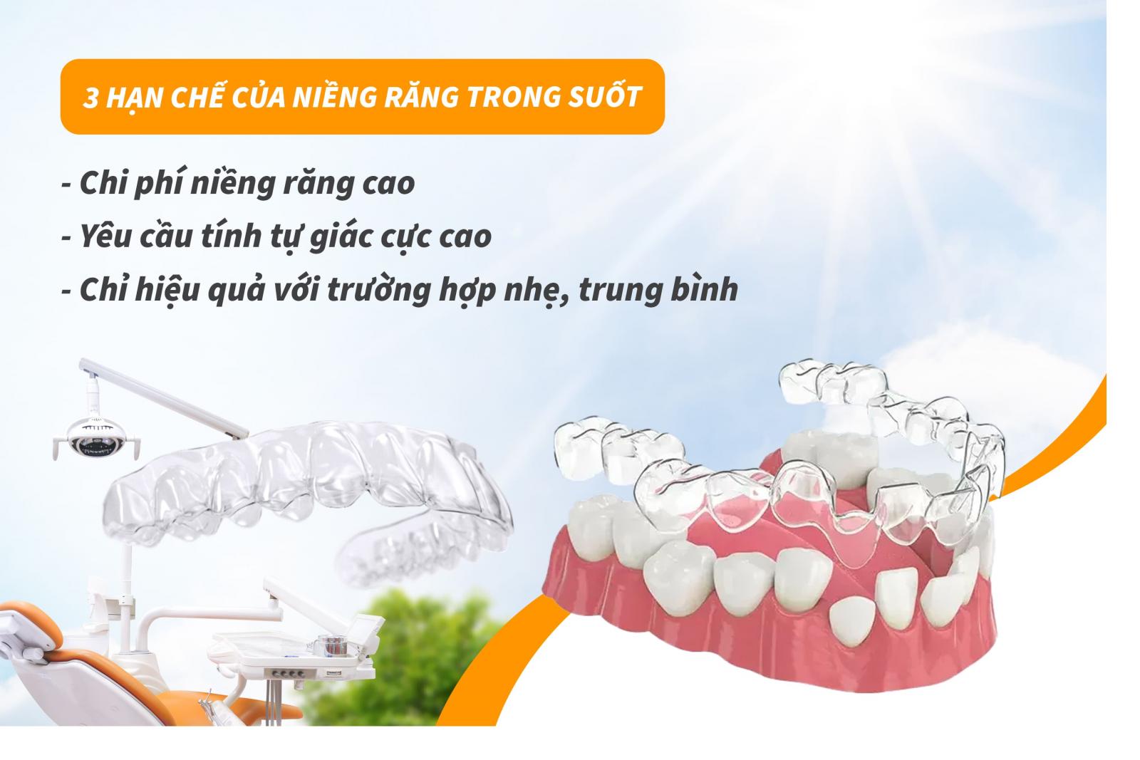 3 hạn chế của niềng răng trong suốt