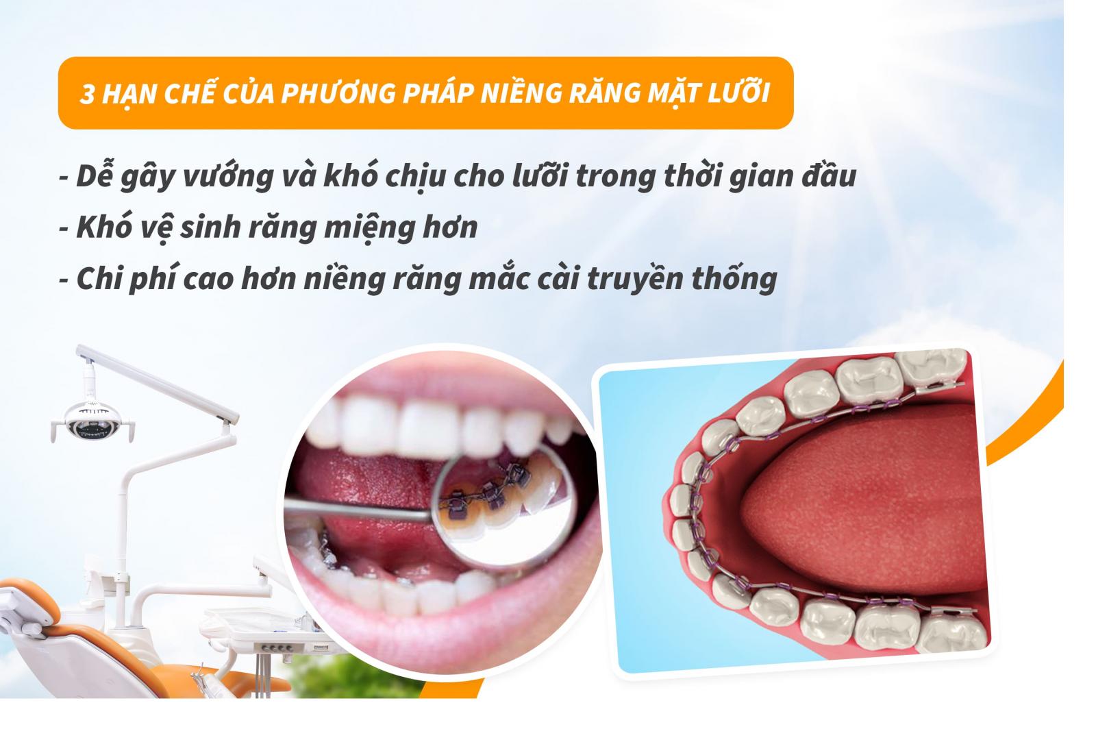 3 hạn chế của phương pháp niềng răng mặt lưỡi