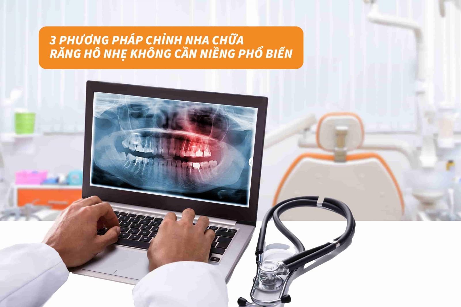 03 phương pháp chỉnh nha chữa răng hô nhẹ không cần niềng phổ biến