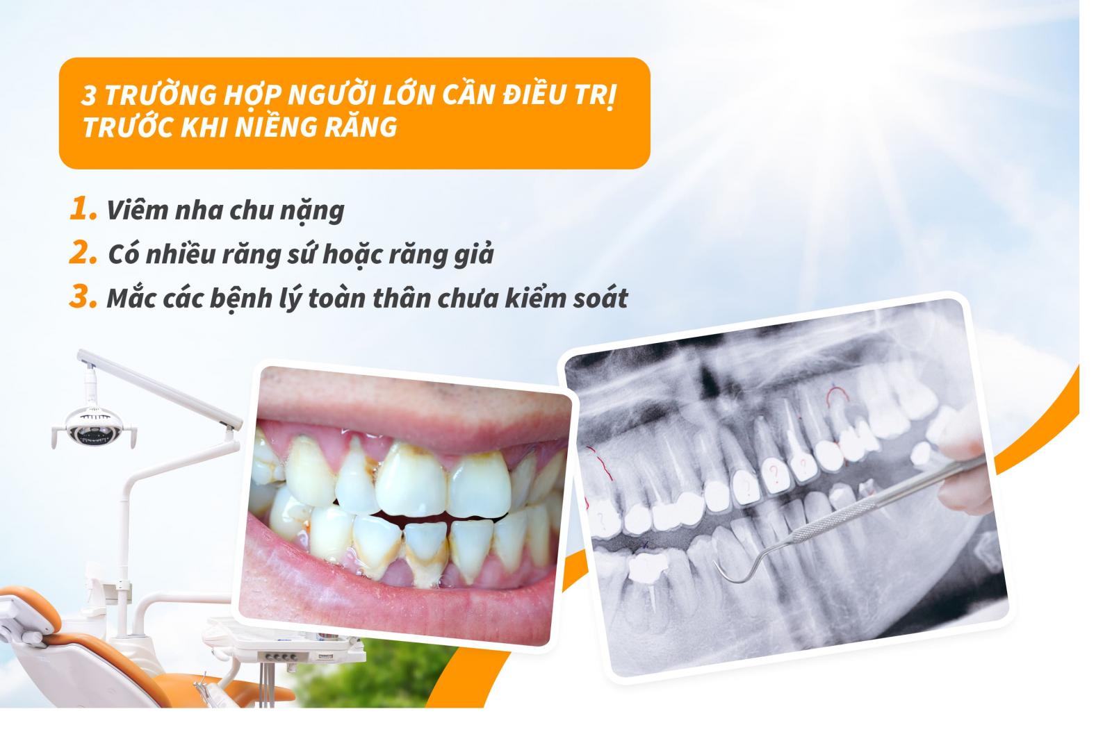 3 trường hợp người lớn cần điều trị trước khi niềng răng