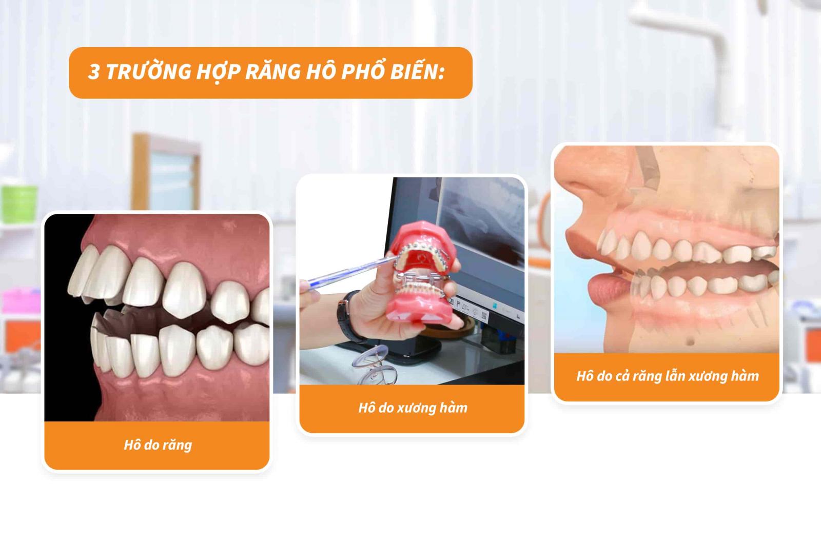 3 trường hợp răng hô phổ biến