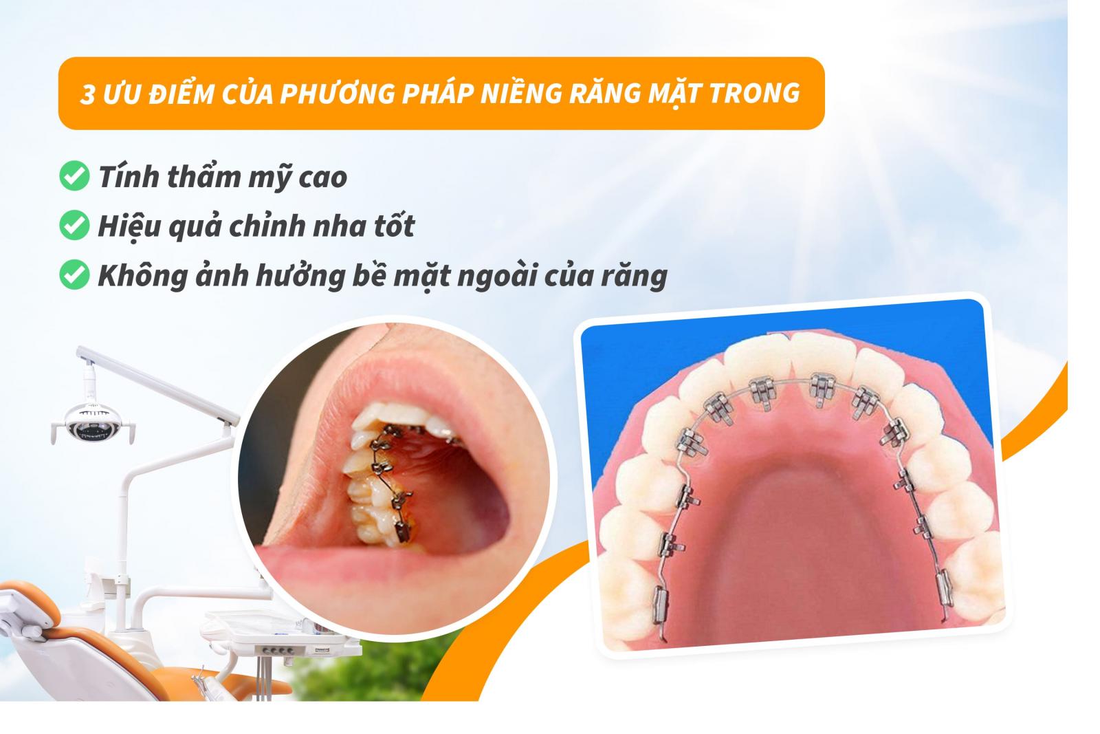 3 ưu điểm của phương pháp niềng răng mặt trong