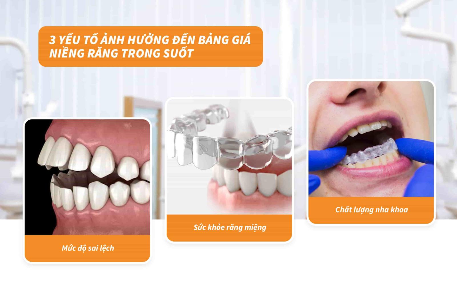 03 yếu tố ảnh hưởng đến bảng giá niềng răng trong suốt