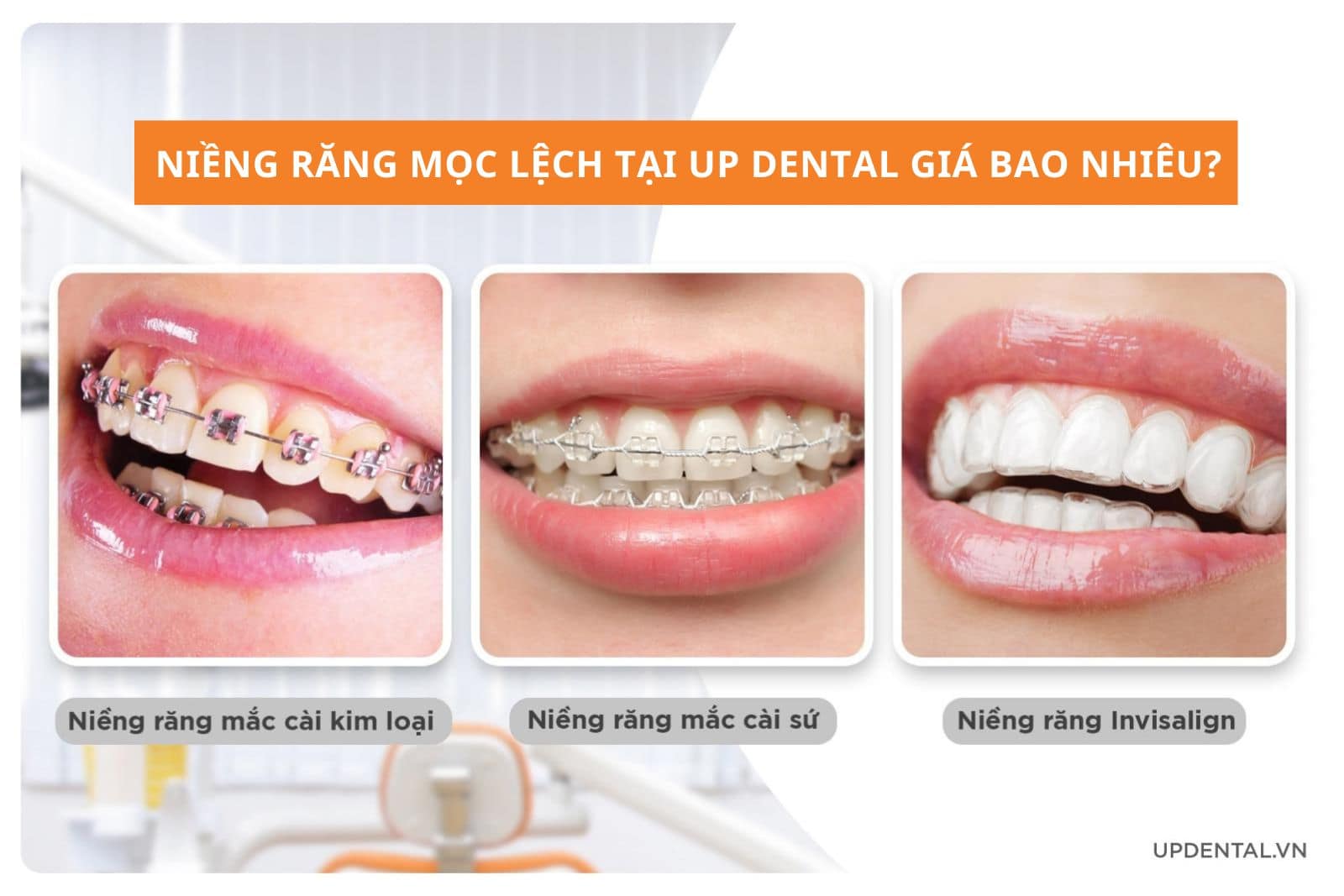 Niềng răng mọc lệch giá bao nhiêu tại nha khoa Up Dental?