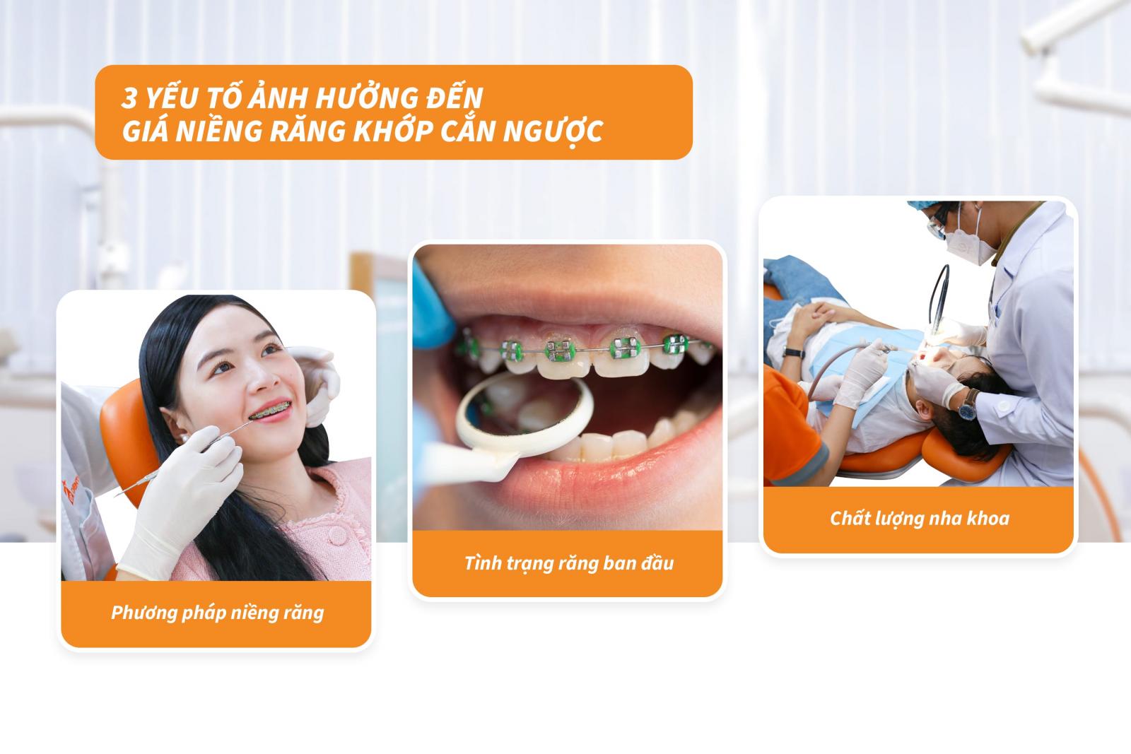 3 yếu tố ảnh hưởng đến giá niềng răng khớp cắn ngược