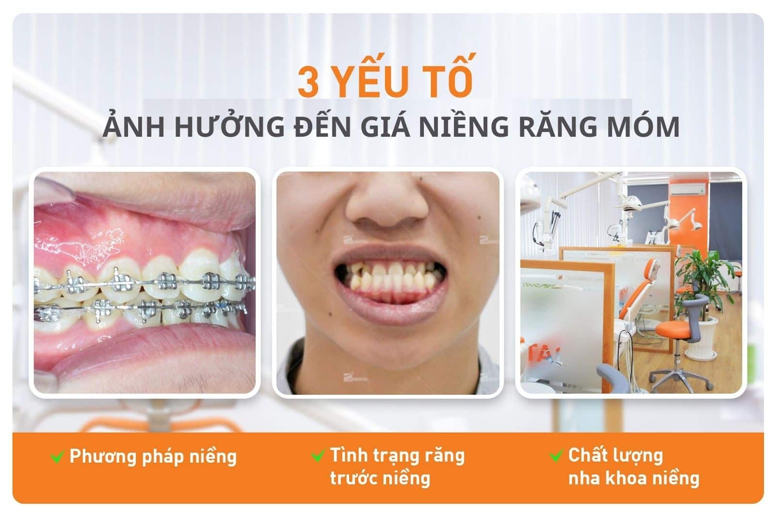 3 yếu tố chính ảnh hưởng đến giá niềng răng móm