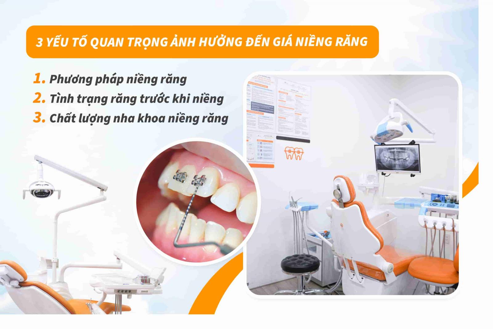 3 yếu tố quan trọng ảnh hưởng đến giá niềng răng