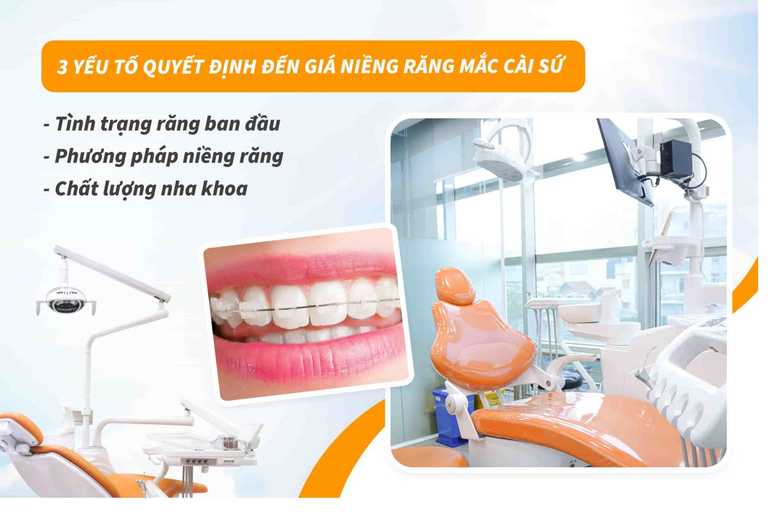 3 yếu tố quyết định đến giá niềng răng mắc cài sứ