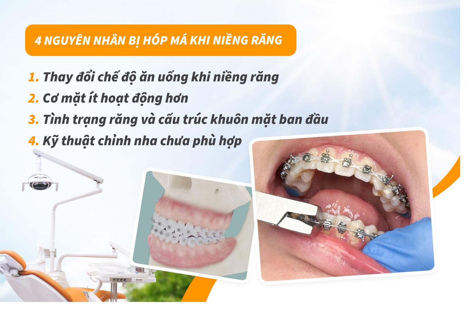 4 nguyên nhân bị hóp má khi niềng răng 