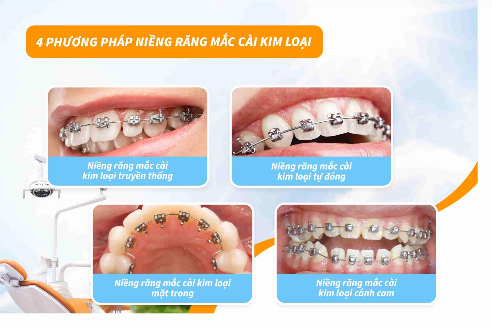4 phương pháp niềng răng mắc cài kim loại