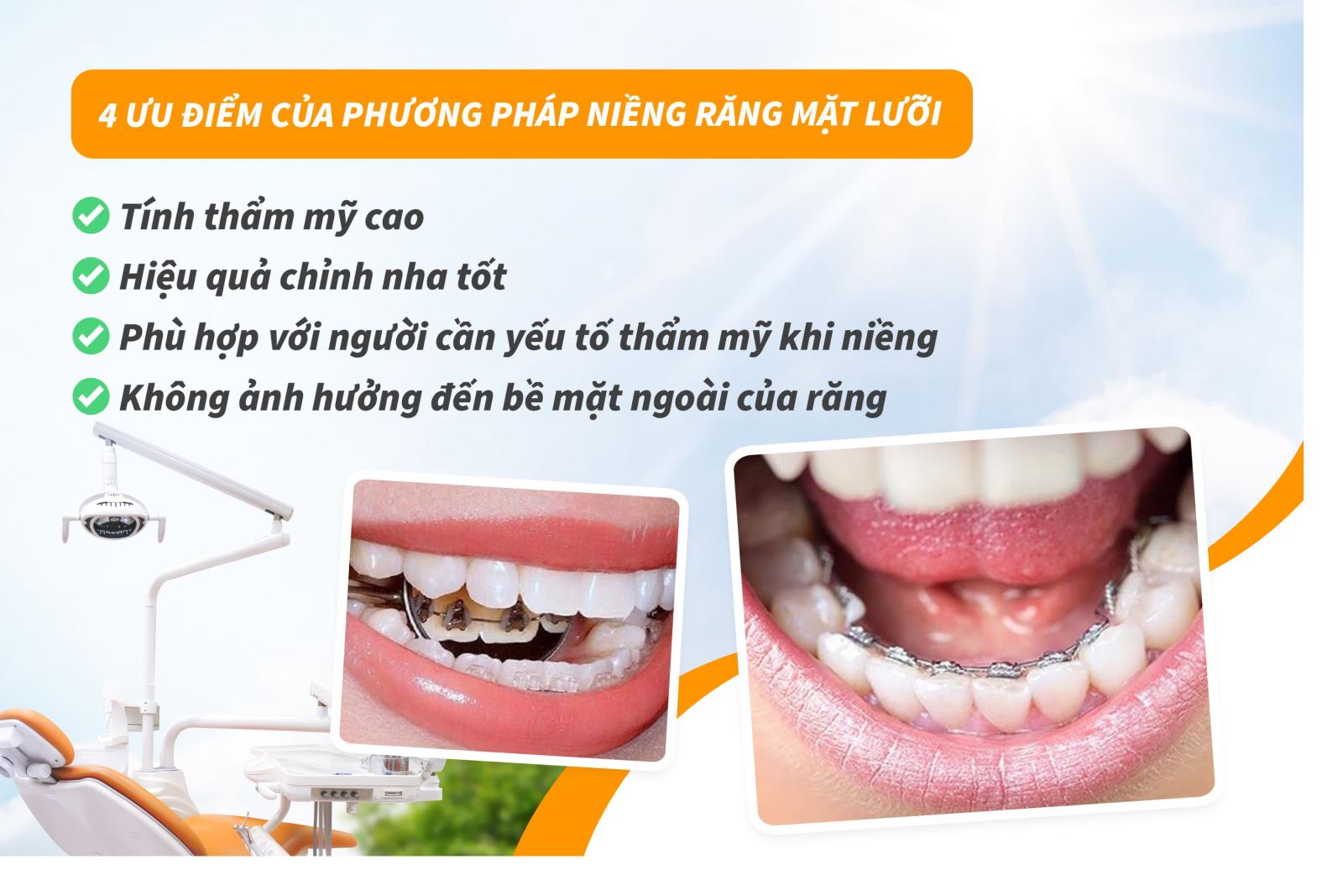 4 ưu điểm của phương pháp niềng răng mặt lưỡi
