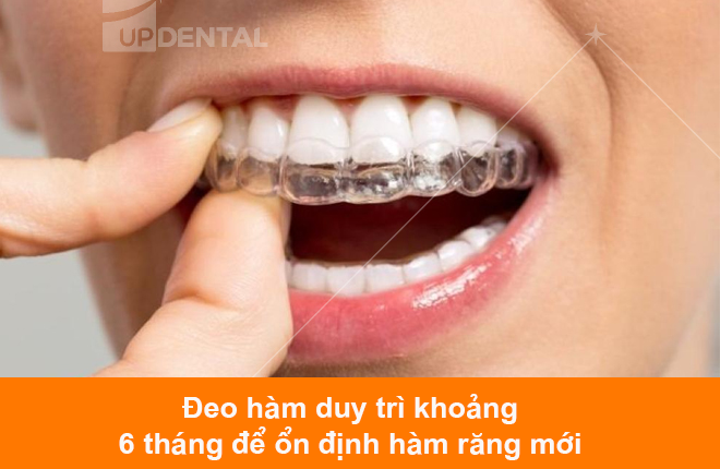 deo ham duy tri sau khi nieng rang