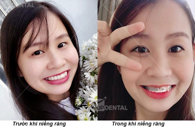 hinh anh nieng rang