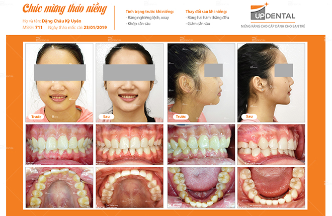 Sự thay đổi trước và sau khi niềng răng lệch lạc