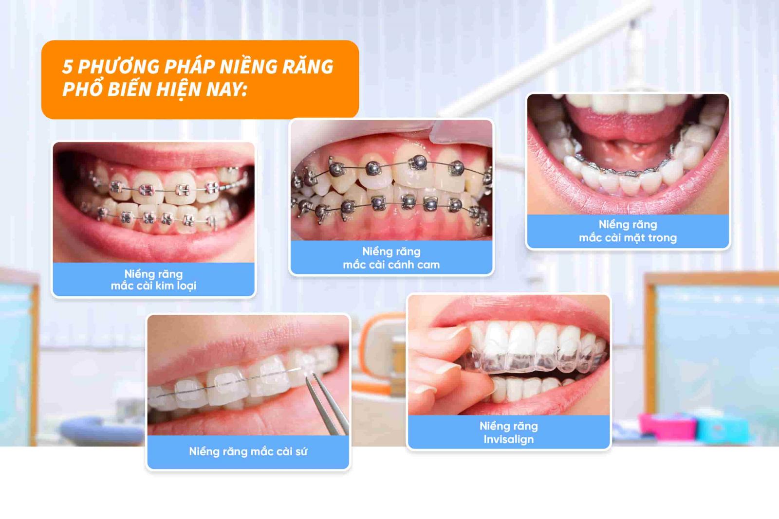 Các phương pháp niềng răng trám và chi phí