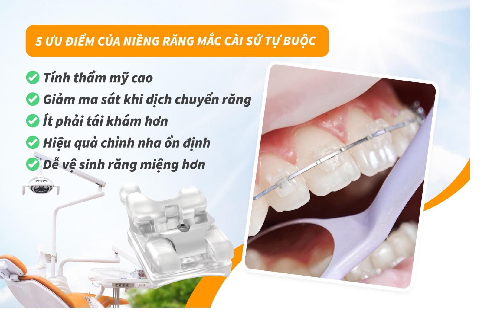 5 ưu điểm của niềng răng mắc cài sứ tự buộc
