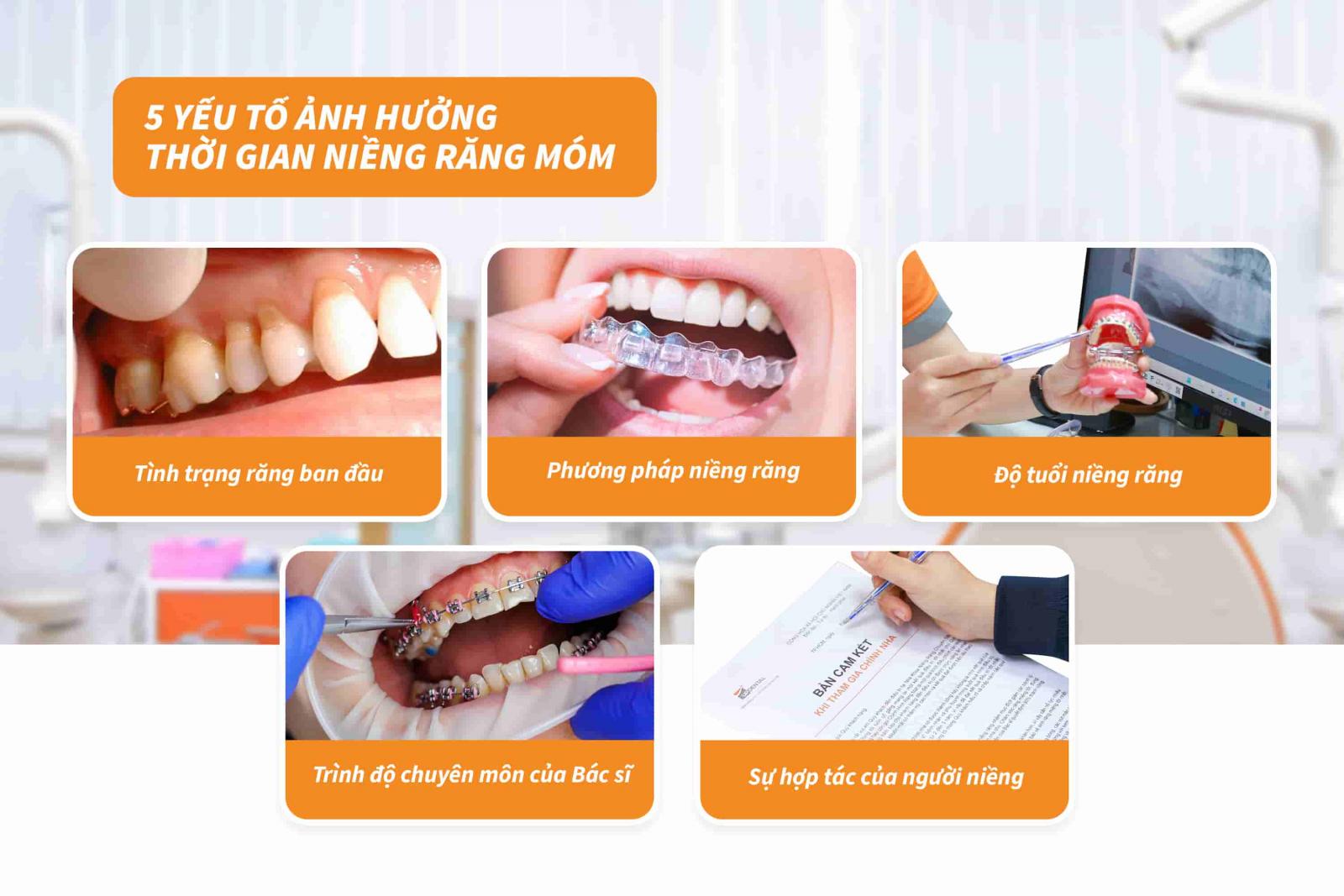 05 yếu tố ảnh hưởng thời gian niềng răng móm: