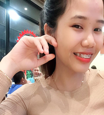 ket qua nieng rang tai nha khoa up dental