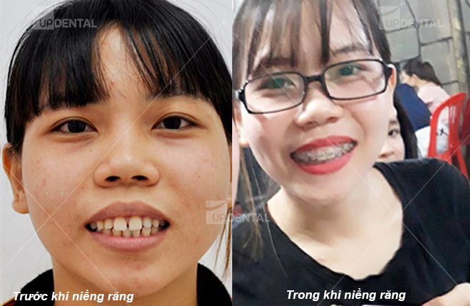 hinh anh truoc va trong qua trinh nieng rang
