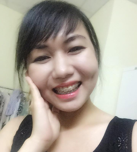 khoe be mac cai kim loai da deo gan 1 nam tai Up Dental