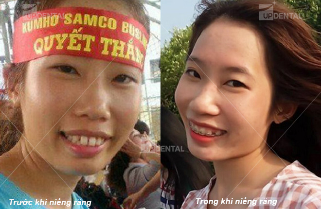 hinh anh truoc khi nieng va trong qua trinh nieng rang