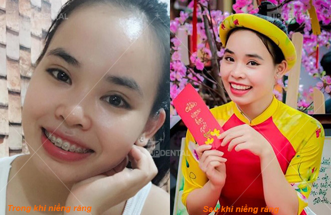 hinh anh truoc khi nieng va sau khi nieng rang