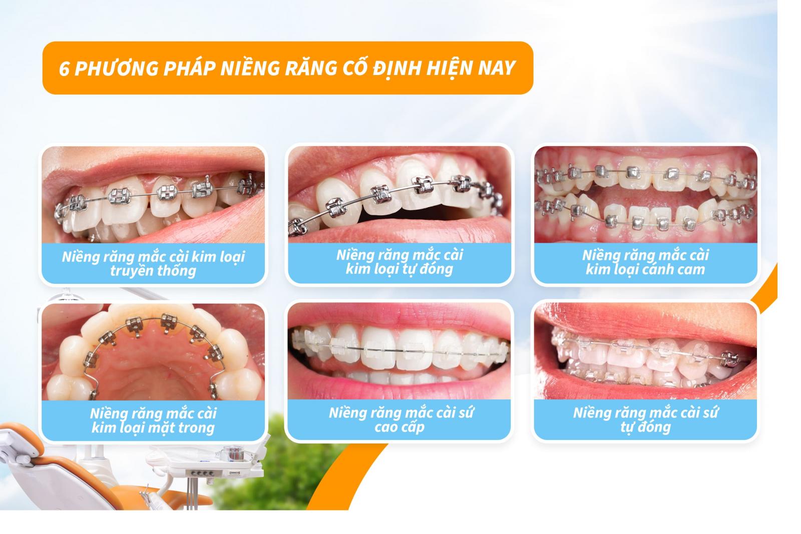 6 phương pháp niềng răng cố định hiện nay