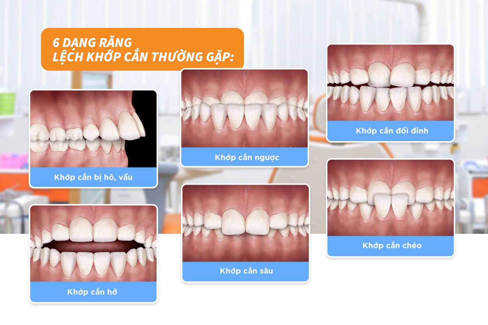 6 dạng răng lệch khớp cắn cơ bản