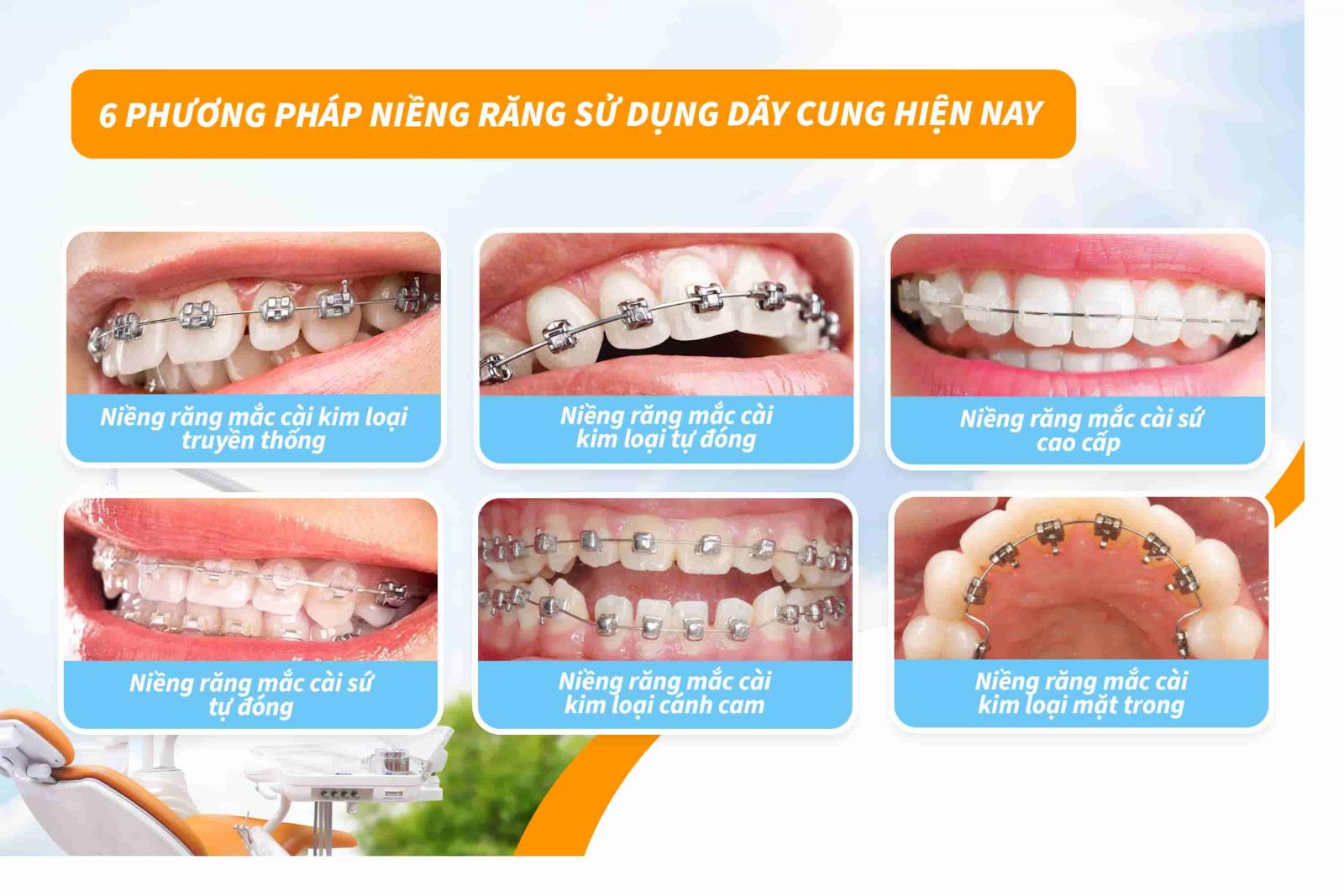 6 phương pháp niềng răng sử dụng dây cung hiện nay