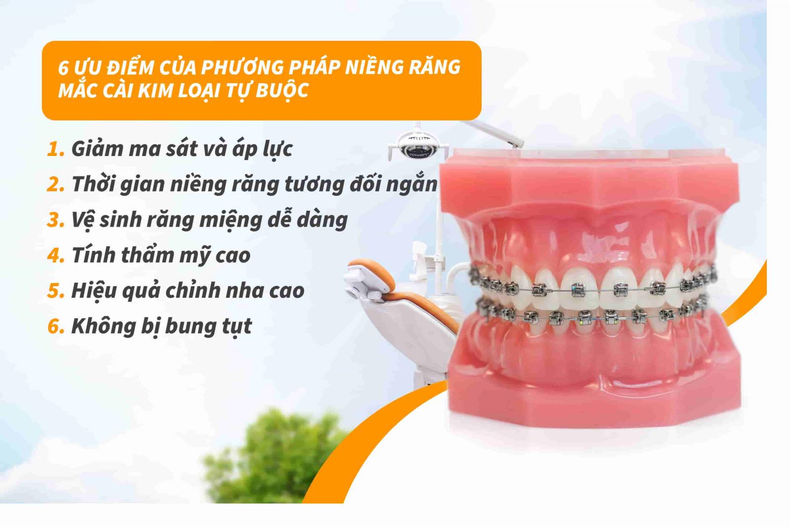 6 ưu điểm của phương pháp niềng răng mắc cài kim loại tự buộc